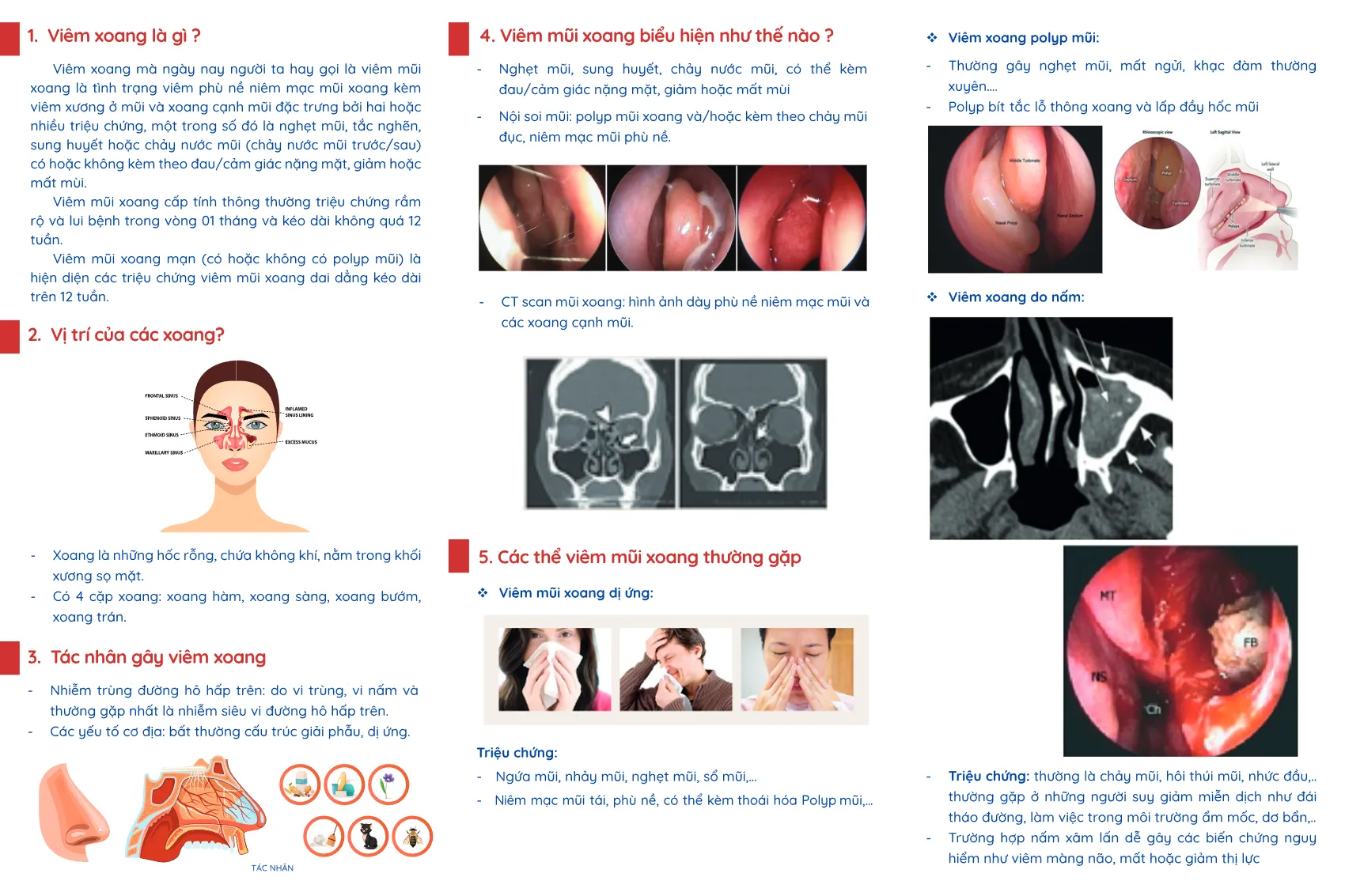 to roi viem mui xoang va nhung dieu can biet_2