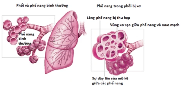 benh-phoi-mo-ke-1.webp
