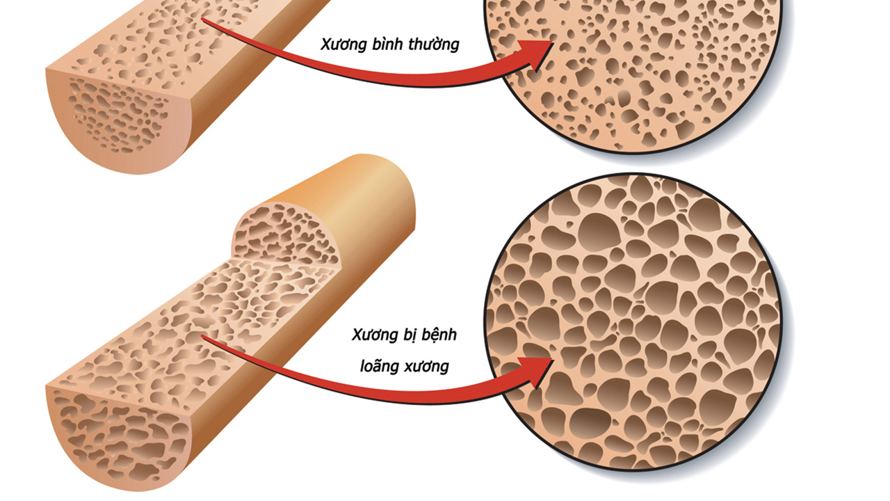 loãng xương.jpg